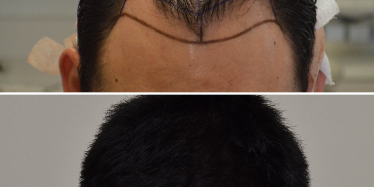 Stem Cell Hair Treatment NYC: A Modern Solution for Hair Restoration