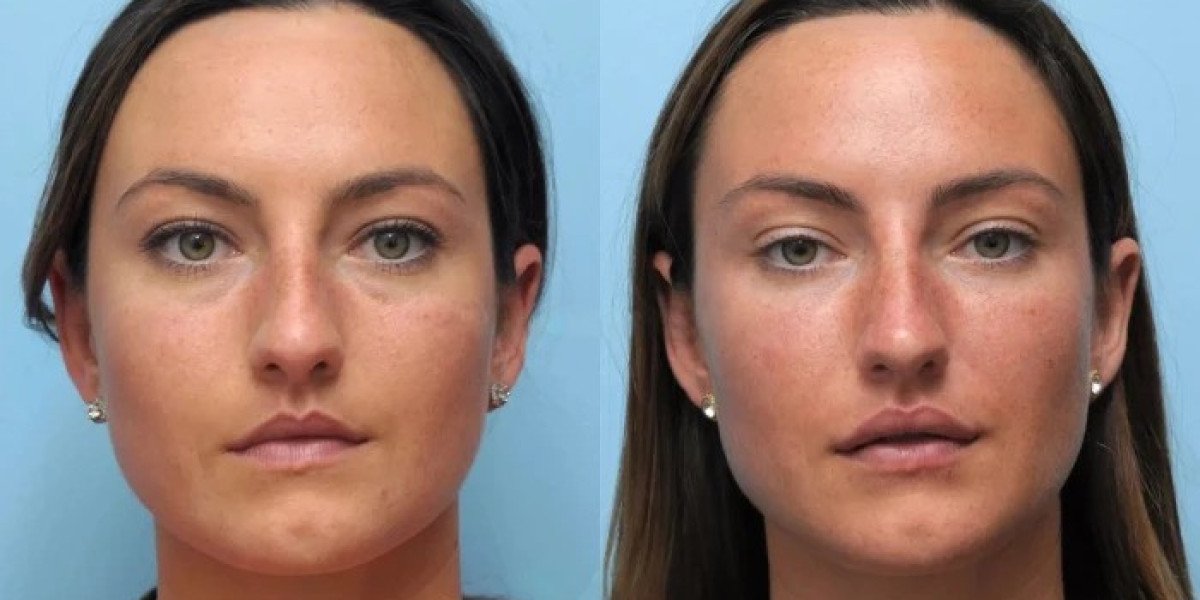 Best Plastic Surgeons in Dubai for Thread Lift High Patient Satisfaction