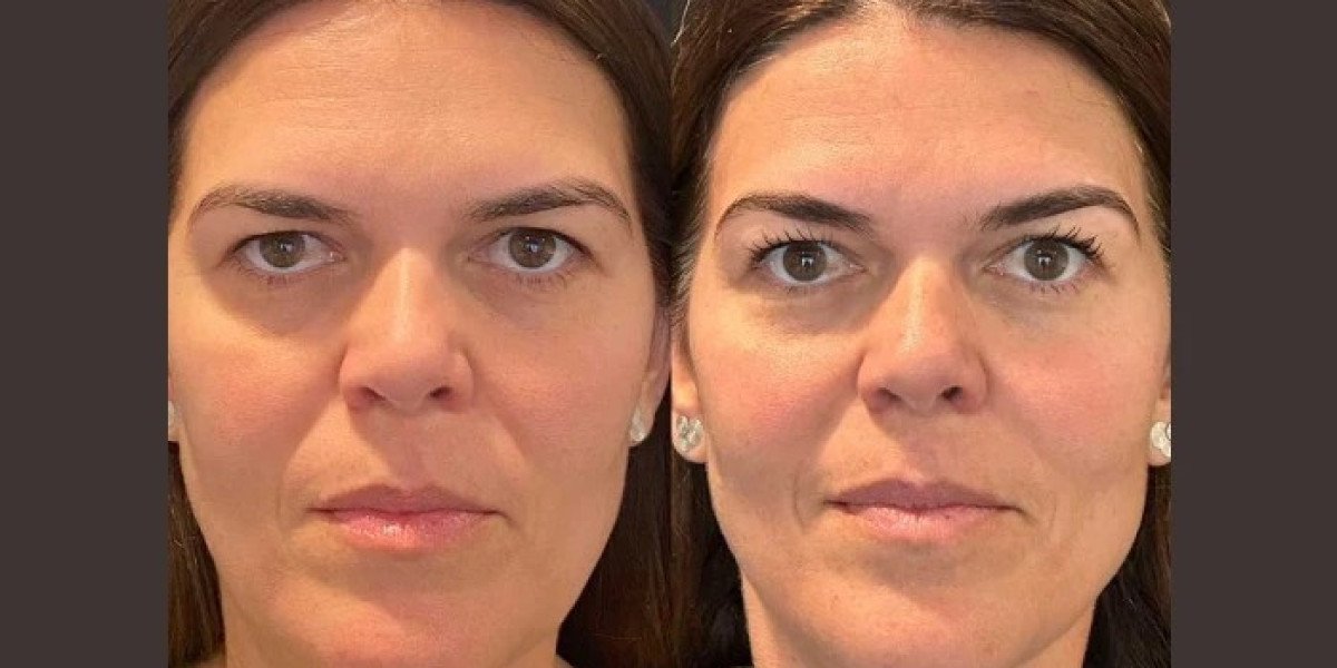 Best Doctors in Dubai Specializing in Facial Thread Lift Treatments