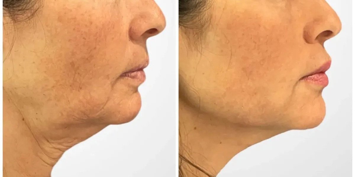Best Plastic Surgeon in Dubai Thread Lift Care Delivering Precise Lifting
